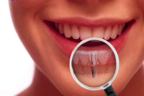 Implantes dentales Alcalá de Henares- Qué son y ventajas