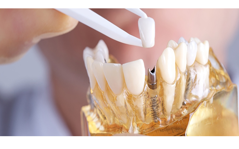 implantes-dentales-dentistas-en-madrid-pilar-garrido.