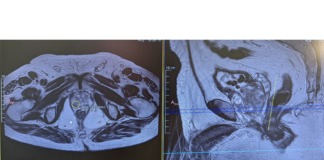 Vithas Madrid Aravaca incorpora máxima tecnología para el diagnóstico del cáncer de próstata